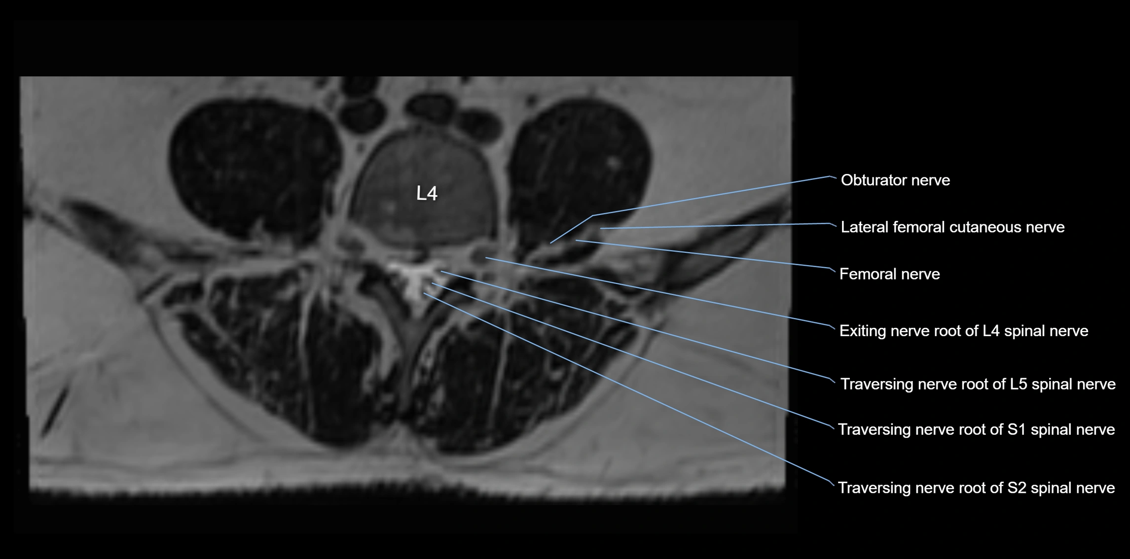 MR lumbosacral plexus axial cross sectional anatomy 3T  radiology  image-img-1008001-00043.webp
